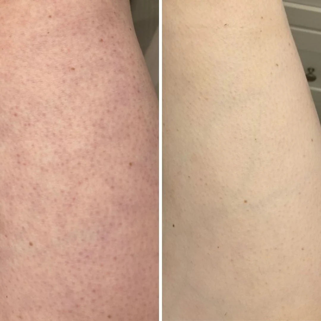 Lymphora Exfolieringsborste