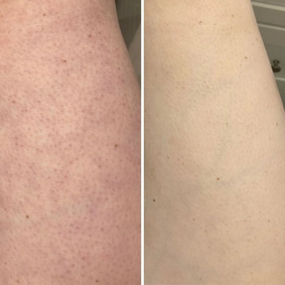 Lymphora Exfolieringsborste